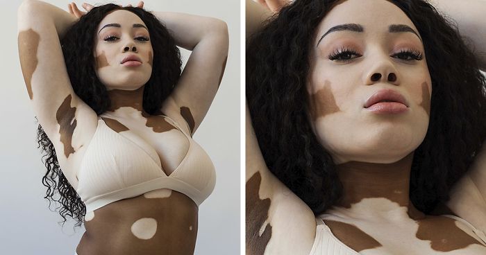 35 Beautiful Women With Vitiligo Shot By A Photographer Who Has The Same Condition