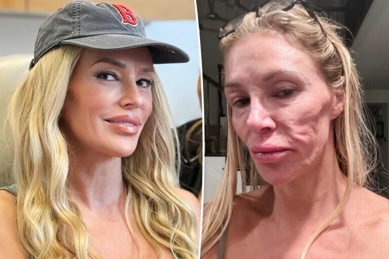 Brandi Glanville debuts new look after crippling facial disfigurement