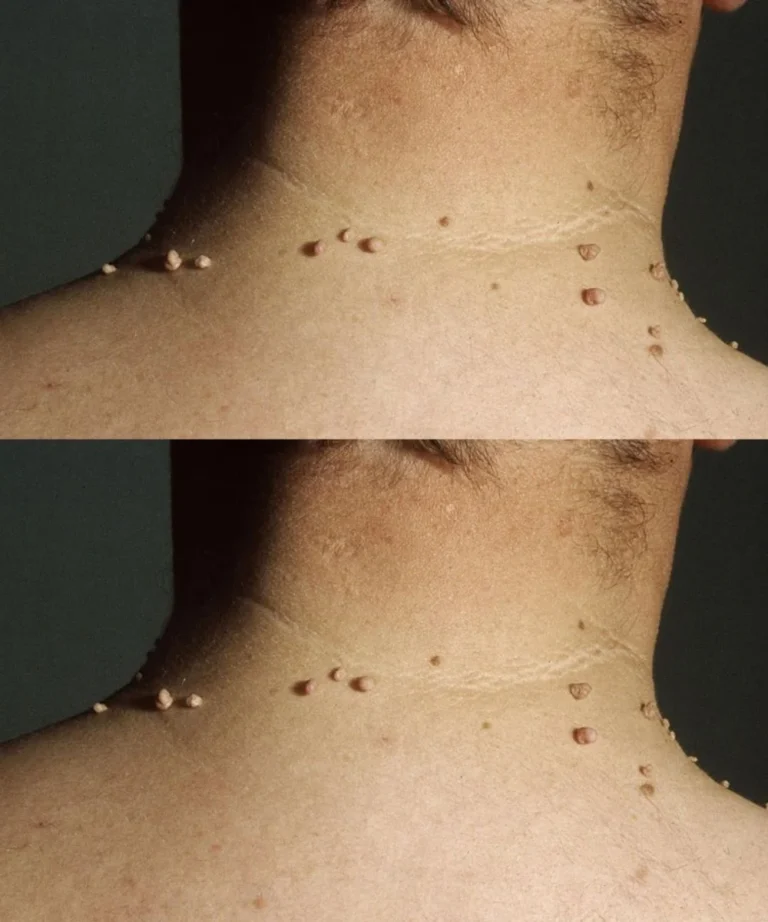 The Most Common Spots for Skin Tags and Why They Form There