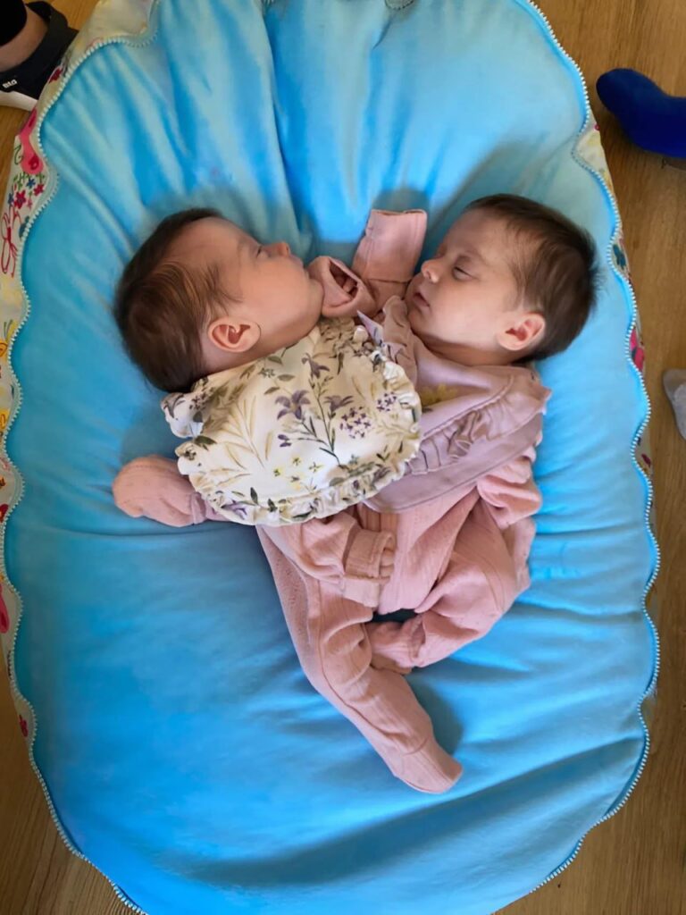 These conjoined twin sisters were born joined at the chest and shared a liver, intestines, and other vital organs 😲