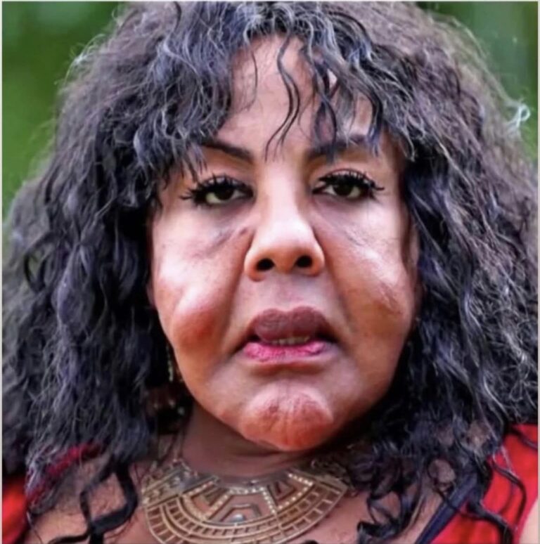 “She Was Injected With Cement — See Her Shocking Transformation 14 Years Later!”