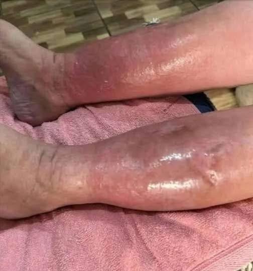Your Feet Are Trying To Warn You Why Ignoring Swollen Ankles Could Be a Massive Mistake for Your Long Term Health