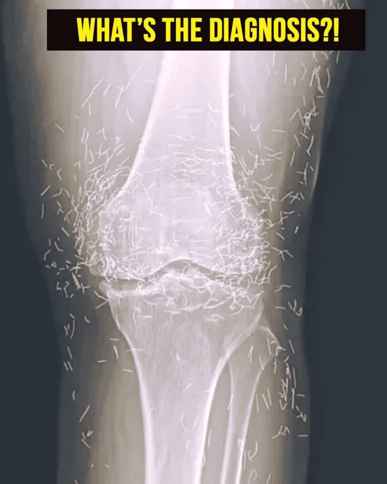 Doctors Discover Unexpected Treasure in Woman’s Knees