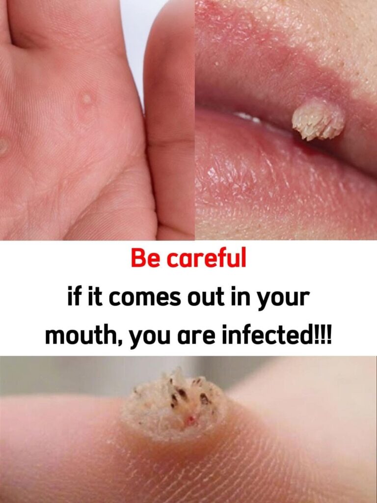 You Have Been Ignoring These Wart Removal Tricks for Years, Doctors Say Some Actually Work But There Is a Catch