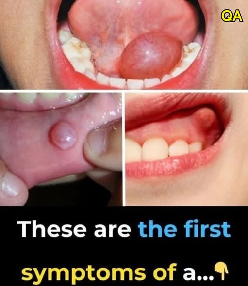 Hidden Dangers in Your Mouth: Early Signs of Oral Can,cer You Should Never Ignore …See more