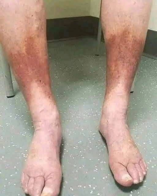 Your Feet Are Screaming for Help: The Silent Warning Signs You’re Ignoring Could Be Fatal