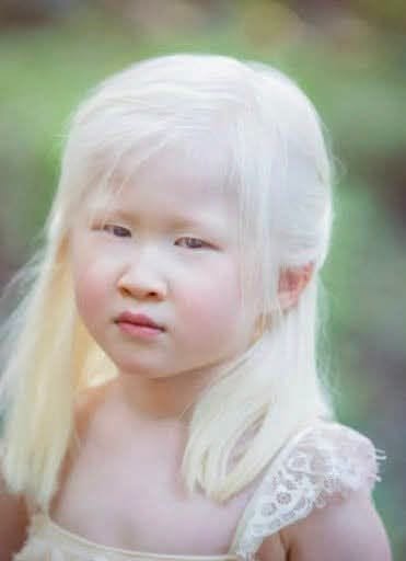 From Rejection to Radiance: The Inspiring Journey of a Little Girl Born With Albinism