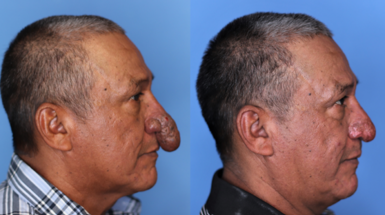 Man’s Life Transformed After Receiving a Long-Awaited Reconstructive Surgery Before the Holidays