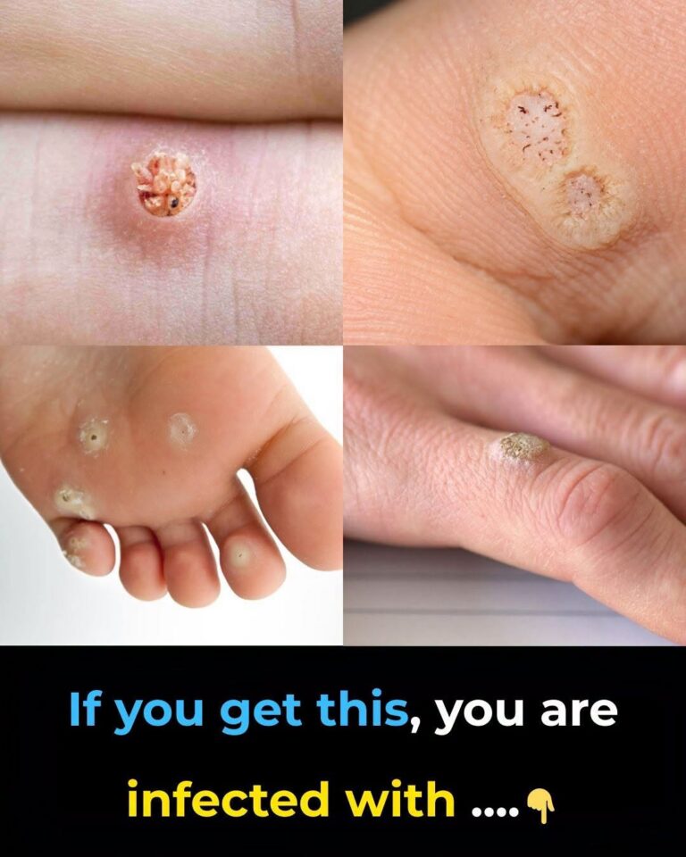 6 Types of Warts (Signs, Symptoms, Home Remedies, and Treatment)