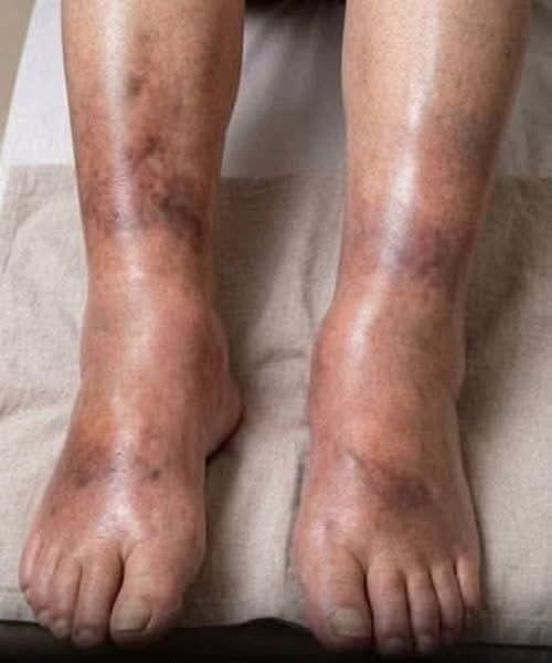 The silent signal: What your swollen legs may reveal about pancreatic cancer
