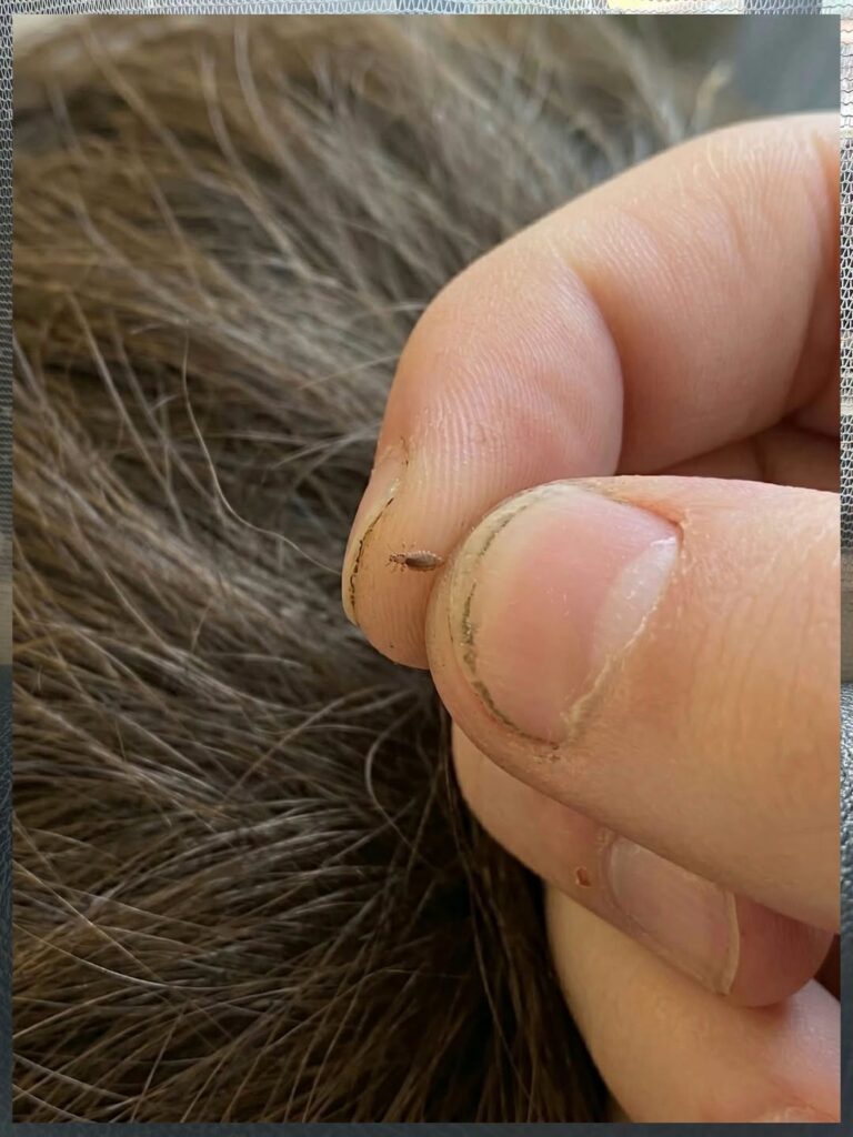 The Hair Hijacker: Identifying the “Tiny Guest” in Your Partner’s Hair